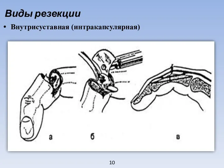 10 Виды резекции Внутрисуставная (интракапсулярная)