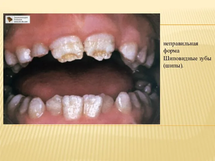 неправильная форма Шиповидные зубы (шипы).