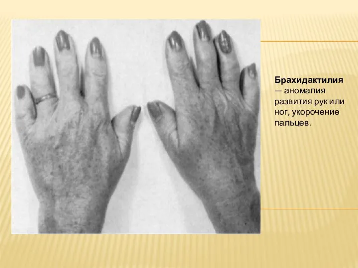 Брахидактилия — аномалия развития рук или ног, укорочение пальцев.