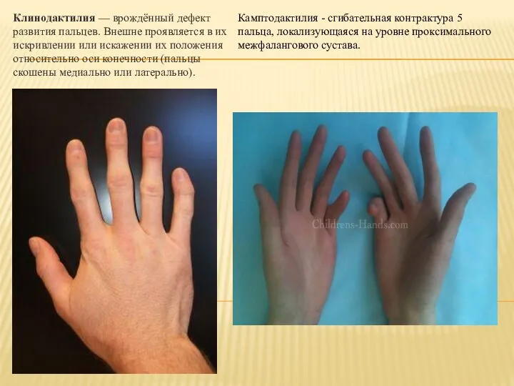 Клинодактилия — врождённый дефект развития пальцев. Внешне проявляется в их искривлении или