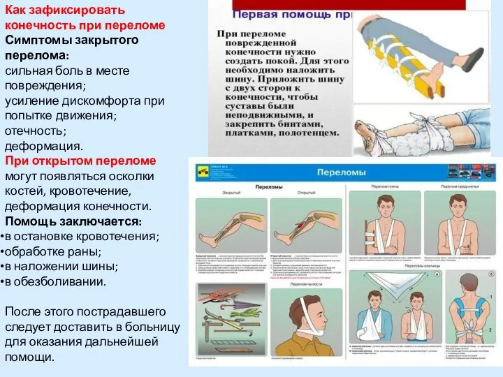 Как зафиксировать конечность при переломе Симптомы закрытого перелома: сильная боль в месте