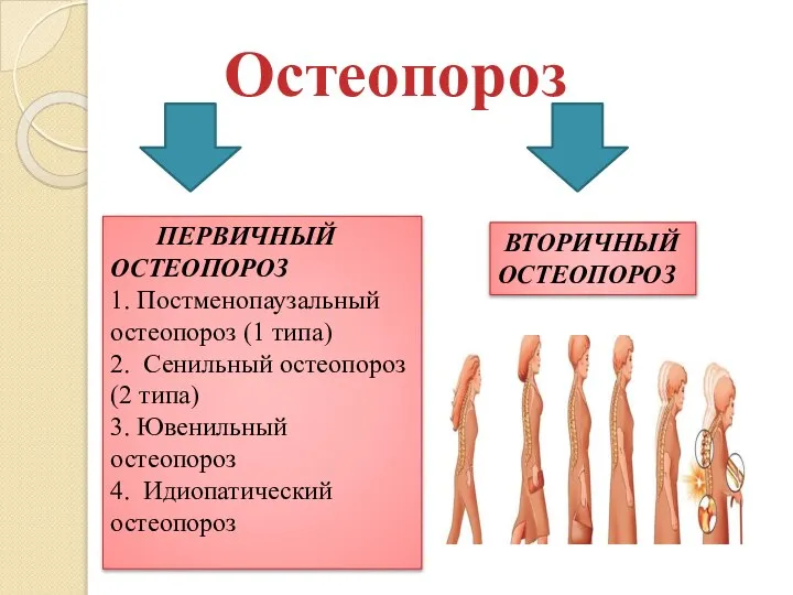 Остеопороз ПЕРВИЧНЫЙ ОСТЕОПОРОЗ 1. Постменопаузальный остеопороз (1 типа) 2. Сенильный остеопороз (2