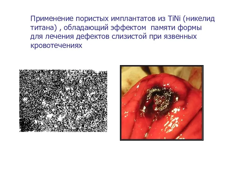 Применение пористых имплантатов из TiNi (никелид титана) , обладающий эффектом памяти формы