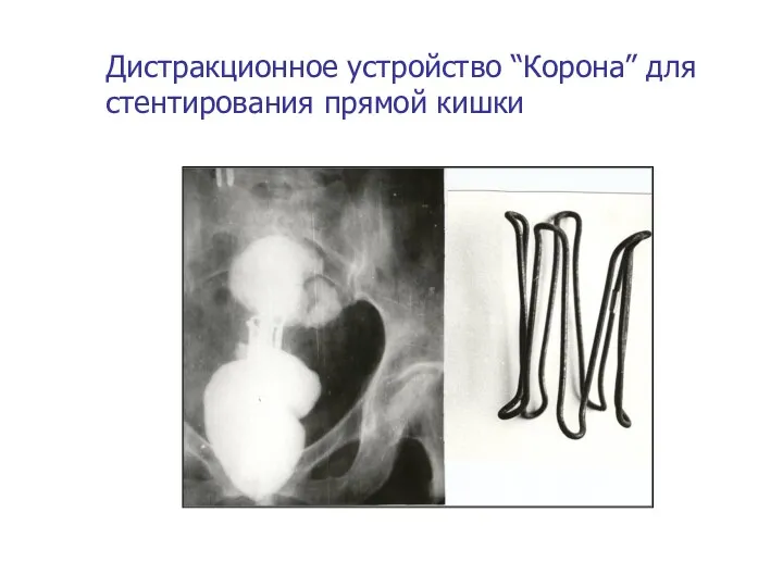 Дистракционное устройство “Корона” для стентирования прямой кишки