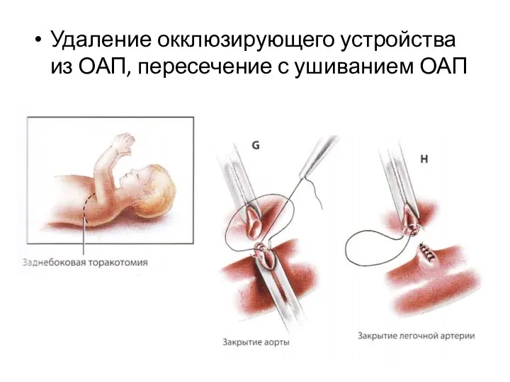 Удаление окклюзирующего устройства из ОАП, пересечение с ушиванием ОАП