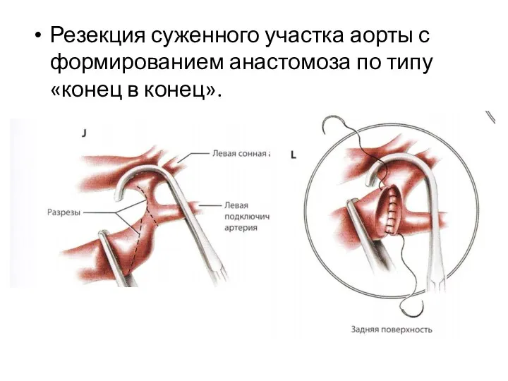 Резекция суженного участка аорты с формированием анастомоза по типу «конец в конец».
