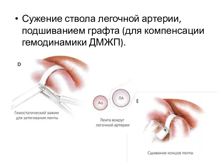 Сужение ствола легочной артерии, подшиванием графта (для компенсации гемодинамики ДМЖП).