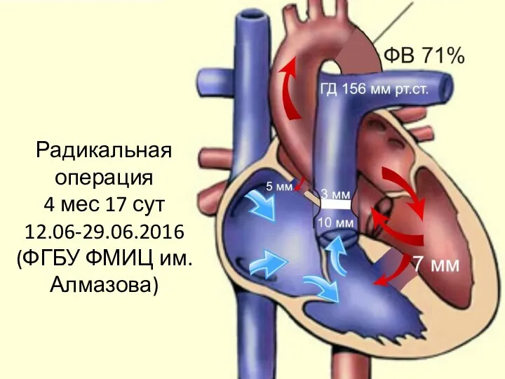 Радикальная операция 4 мес 17 сут 12.06-29.06.2016 (ФГБУ ФМИЦ им. Алмазова)