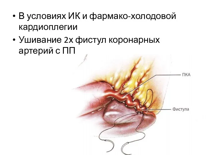 В условиях ИК и фармако-холодовой кардиоплегии Ушивание 2х фистул коронарных артерий с ПП