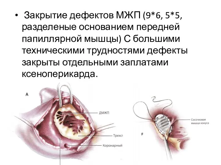 Закрытие дефектов МЖП (9*6, 5*5, разделеные основанием передней папиллярной мышцы) С большими