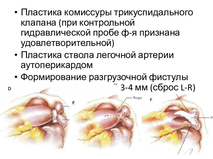 Пластика комиссуры трикуспидального клапана (при контрольной гидравлической пробе ф-я признана удовлетворительной) Пластика