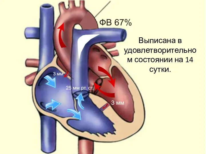 Выписана в удовлетворительном состоянии на 14 сутки.