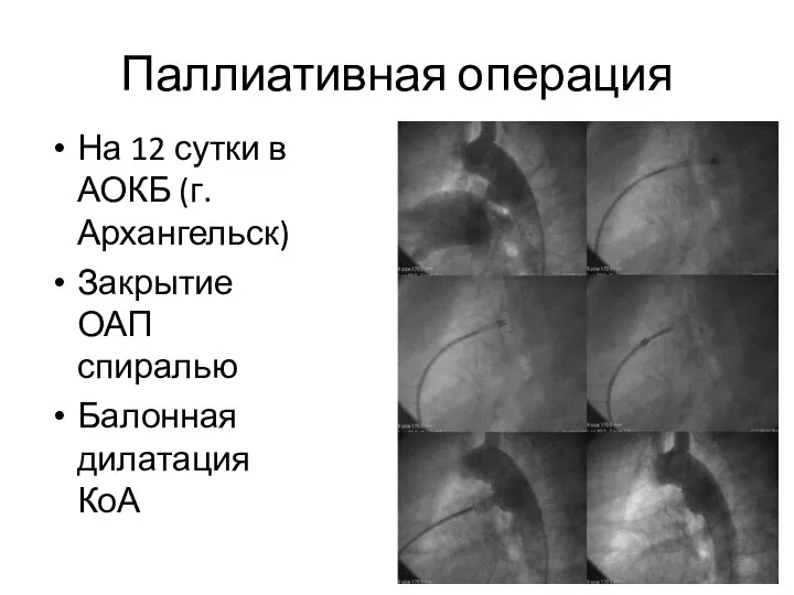 Паллиативная операция На 12 сутки в АОКБ (г. Архангельск) Закрытие ОАП спиралью Балонная дилатация КоА