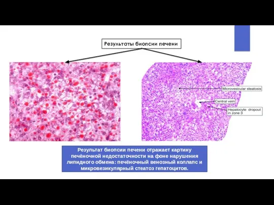 Результат биопсии печени отражает картину печёночной недостаточности на фоне нарушения липидного обмена: