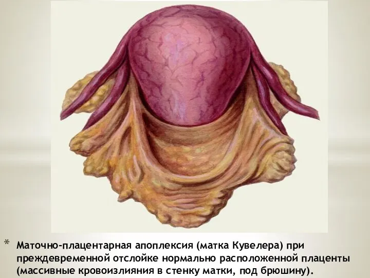 Маточно-плацентарная апоплексия (матка Кувелера) при преждевременной отслойке нормально расположенной плаценты (массивные кровоизлияния