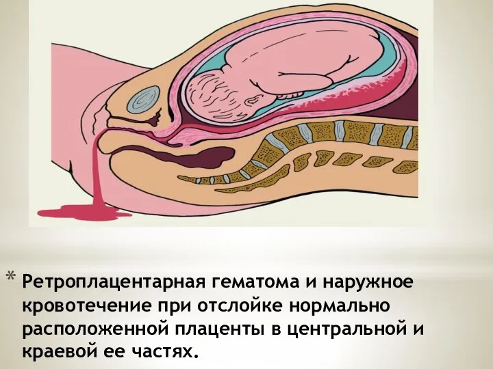 Ретроплацентарная гематома и наружное кровотечение при отслойке нормально расположенной плаценты в центральной и краевой ее частях.