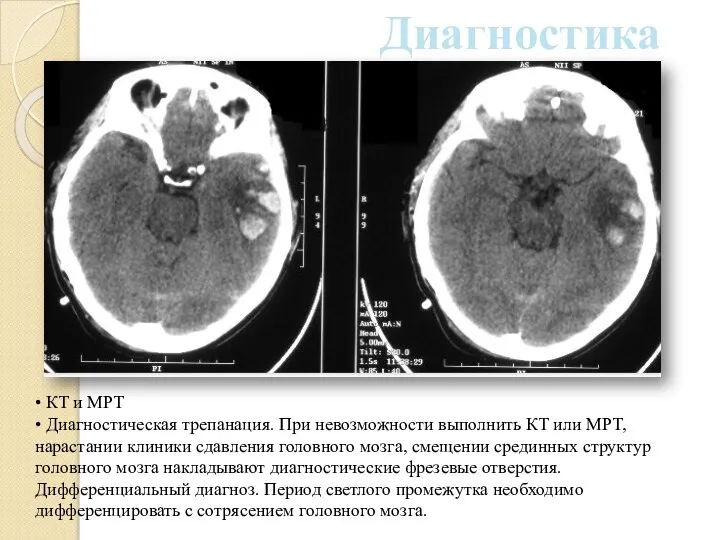 • КТ и МРТ • Диагностическая трепанация. При невозможности выполнить КТ или