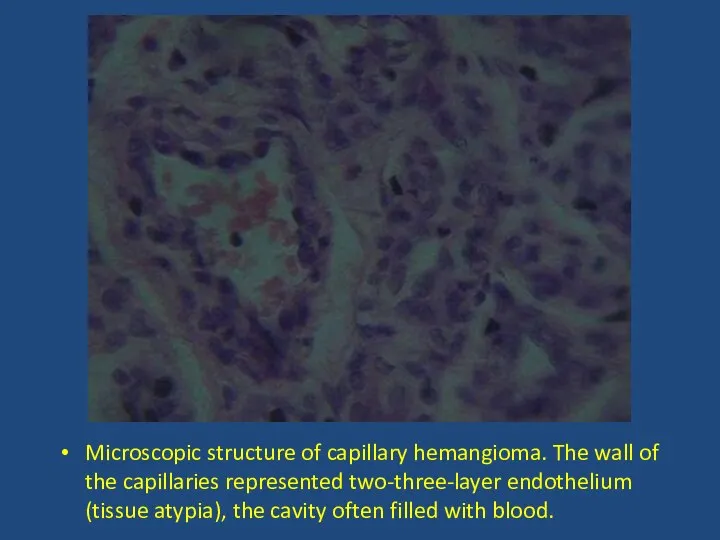 Microscopic structure of capillary hemangioma. The wall of the capillaries represented two-three-layer