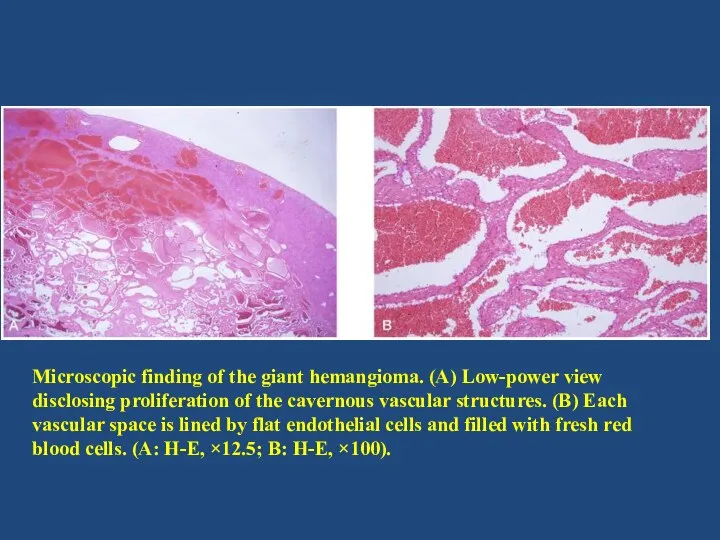 Microscopic finding of the giant hemangioma. (A) Low-power view disclosing proliferation of