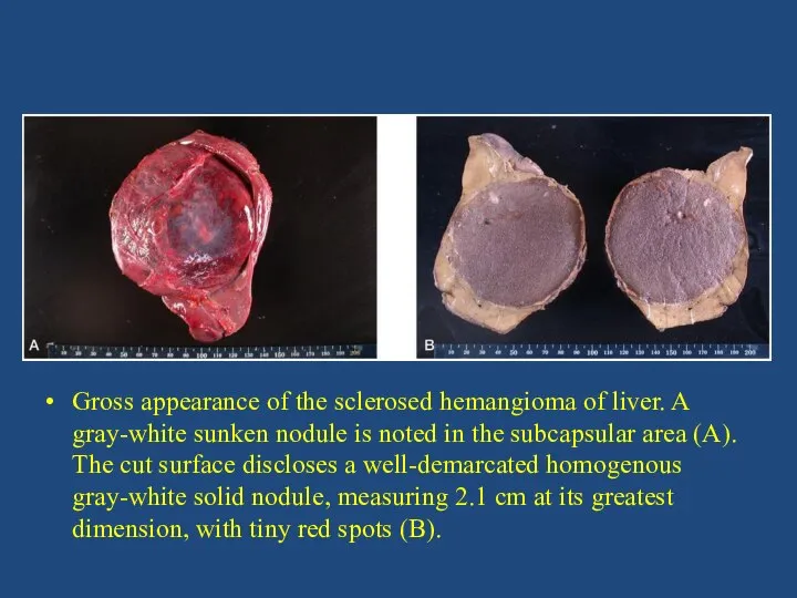 Gross appearance of the sclerosed hemangioma of liver. A gray-white sunken nodule