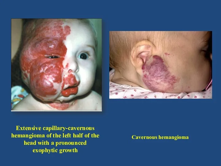 Extensive capillary-cavernous hemangioma of the left half of the head with a