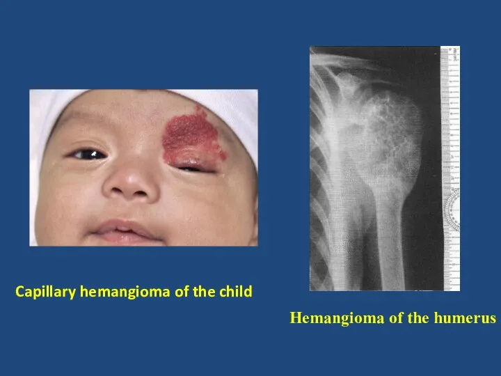 Capillary hemangioma of the child Hemangioma of the humerus