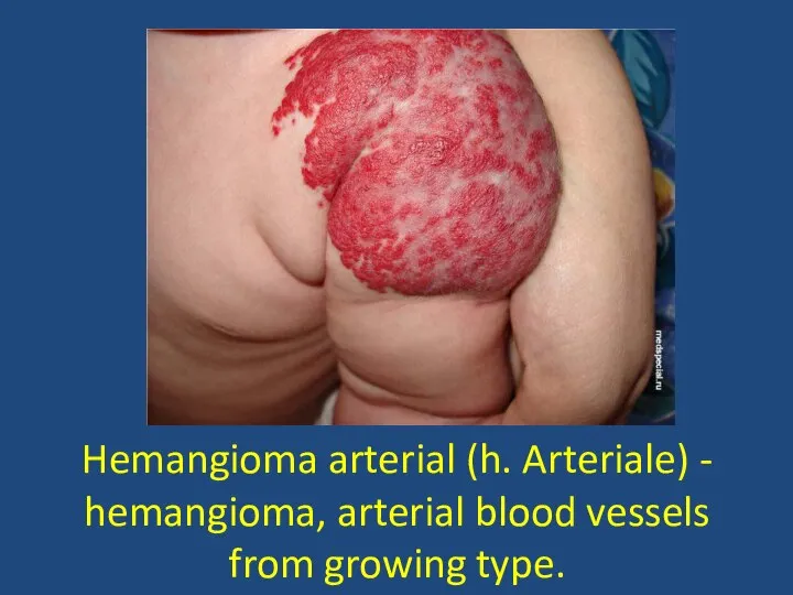 Hemangioma arterial (h. Arteriale) - hemangioma, arterial blood vessels from growing type.