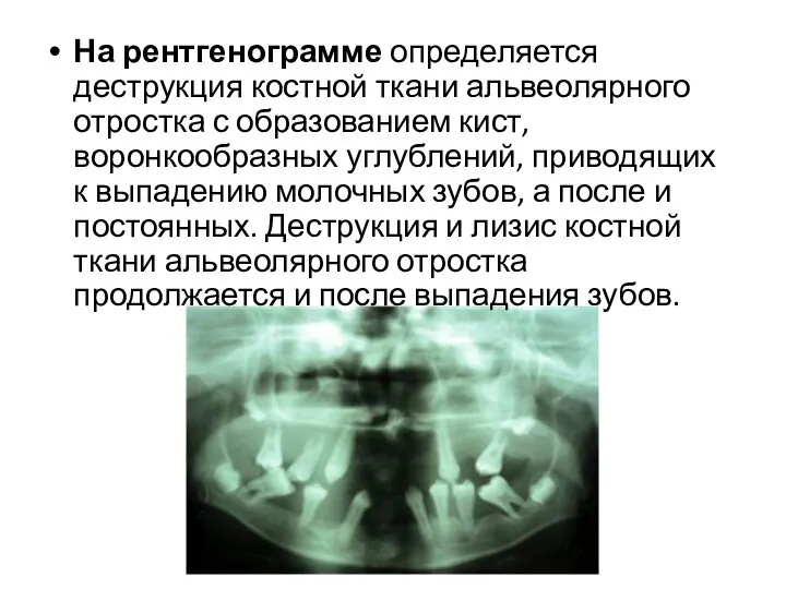 На рентгенограмме определяется деструкция костной ткани альвеолярного отростка с образованием кист, воронкообразных