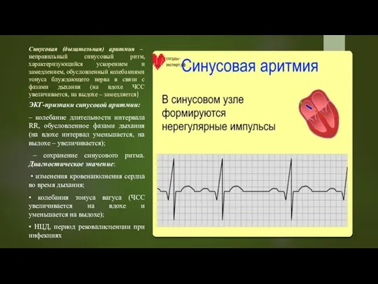 Синусовая (дыхательная) аритмия – неправильный синусовый ритм, характеризующийся ускорением и замедлением, обусловленный