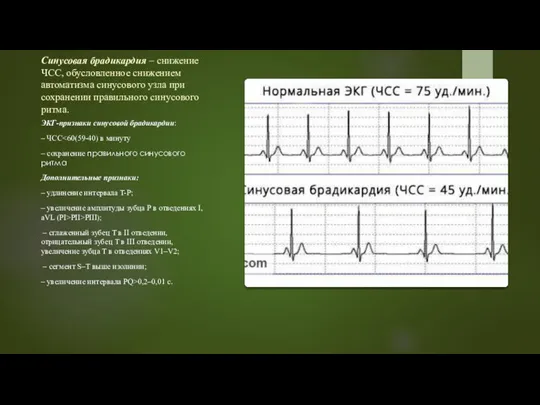 Синусовая брадикардия – снижение ЧСС, обусловленное снижением автоматизма синусового узла при сохранении