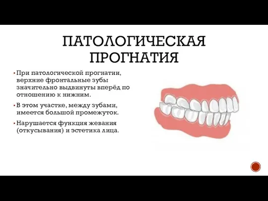 ПАТОЛОГИЧЕСКАЯ ПРОГНАТИЯ При патологической прогнатии, верхние фронтальные зубы значительно выдвинуты вперёд по