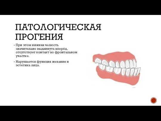 ПАТОЛОГИЧЕСКАЯ ПРОГЕНИЯ При этом нижняя челюсть значительно выдвинута вперёд, отсутствует контакт во