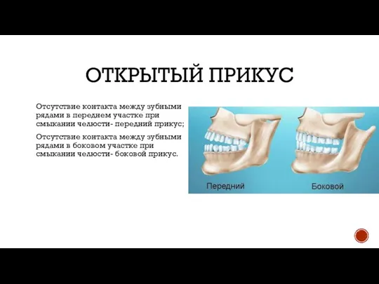 ОТКРЫТЫЙ ПРИКУС Отсутствие контакта между зубными рядами в переднем участке при смыкании