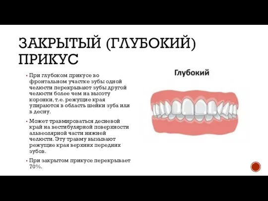 ЗАКРЫТЫЙ (ГЛУБОКИЙ) ПРИКУС При глубоком прикусе во фронтальном участке зубы одной челюсти