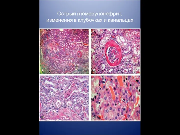 Острый гломерулонефрит, изменения в клубочках и канальцах