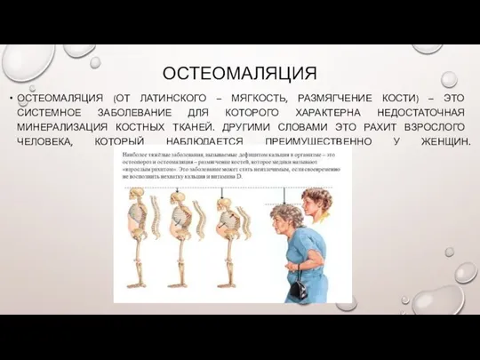 ОСТЕОМАЛЯЦИЯ ОСТЕОМАЛЯЦИЯ (ОТ ЛАТИНСКОГО – МЯГКОСТЬ, РАЗМЯГЧЕНИЕ КОСТИ) – ЭТО СИСТЕМНОЕ ЗАБОЛЕВАНИЕ