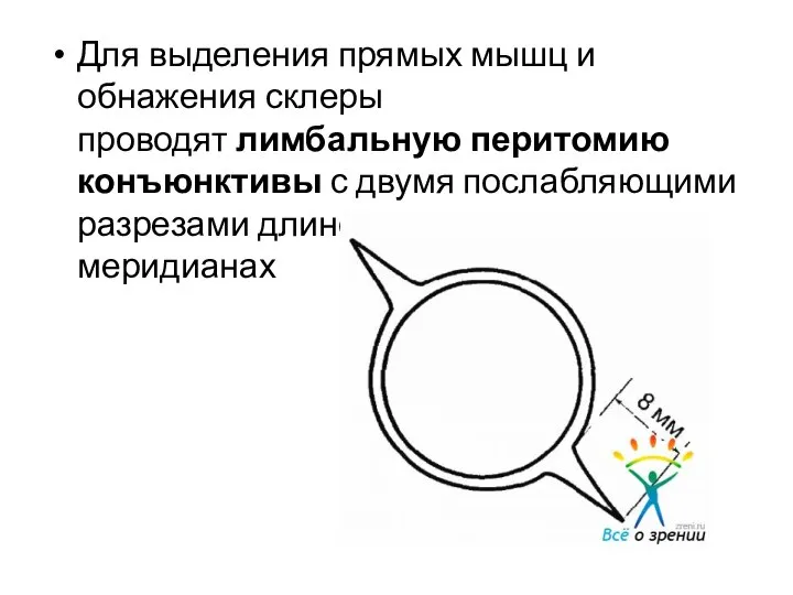 Для выделения прямых мышц и обнажения склеры проводят лимбальную перитомию конъюнктивы с