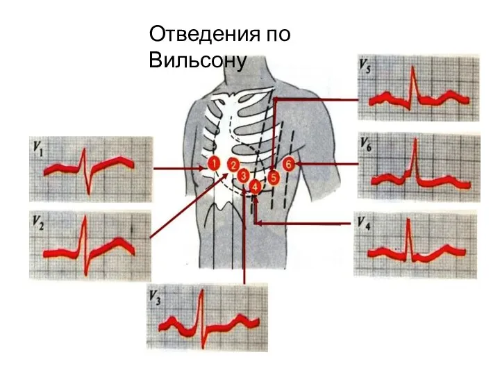 Отведения по Вильсону