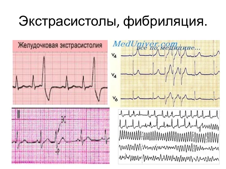 Экстрасистолы, фибриляция.