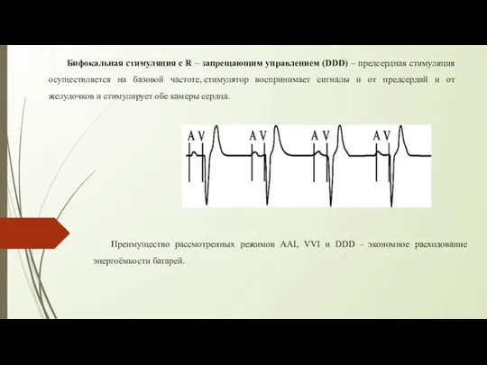 Бифокальная стимуляция с R – запрещающим управлением (DDD) – предсердная стимуляция осуществляется