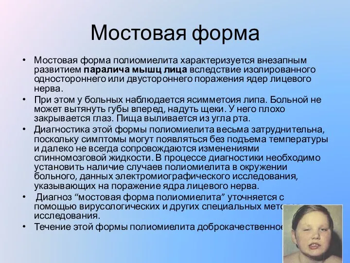 Мостовая форма Мостовая форма полиомиелита характеризуется внезапным развитием паралича мышц лица вследствие