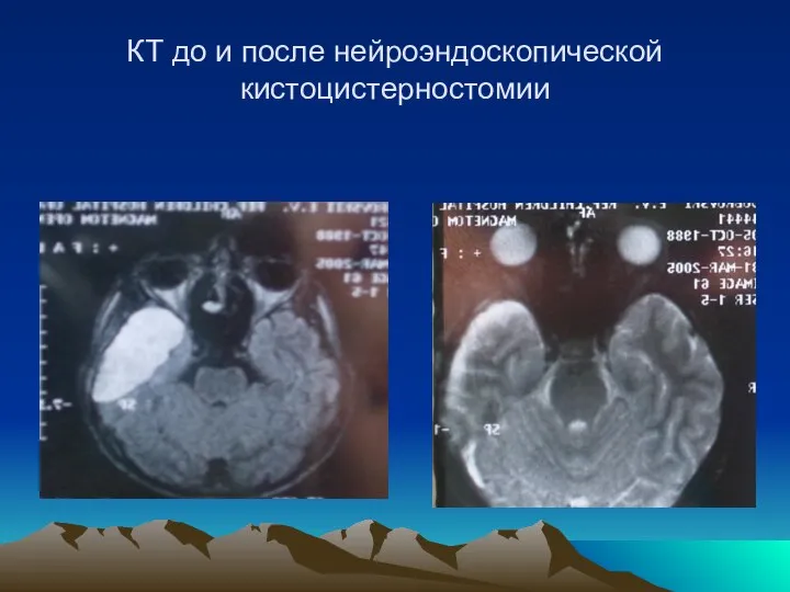 КТ до и после нейроэндоскопической кистоцистерностомии