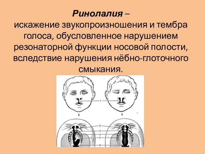 Ринолалия – искажение звукопроизношения и тембра голоса, обусловленное нарушением резонаторной функции носовой