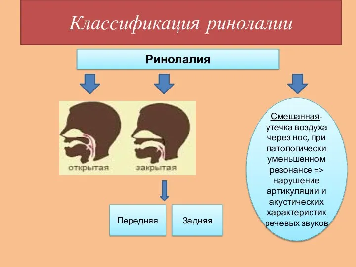 Классификация ринолалии Ринолалия Смешанная- утечка воздуха через нос, при патологически уменьшенном резонансе