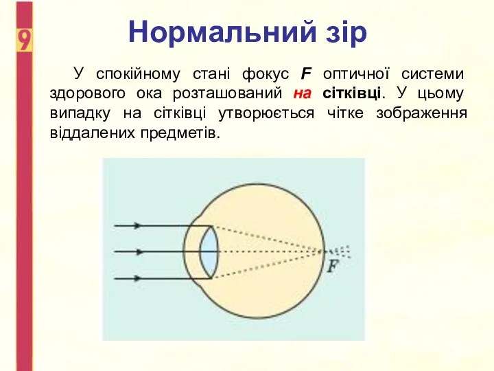 Нормальний зір У спокійному стані фокус F оптичної системи здорового ока розташований