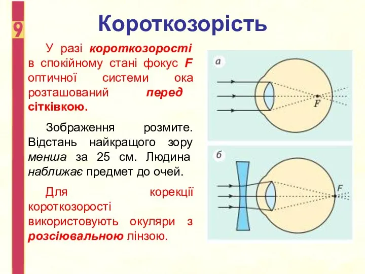 Короткозорість У разі короткозорості в спокійному стані фокус F оптичної системи ока