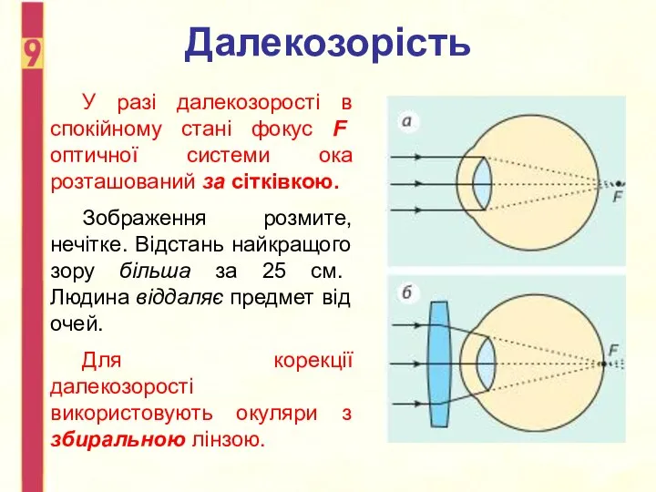 Далекозорість У разі далекозорості в спокійному стані фокус F оптичної системи ока