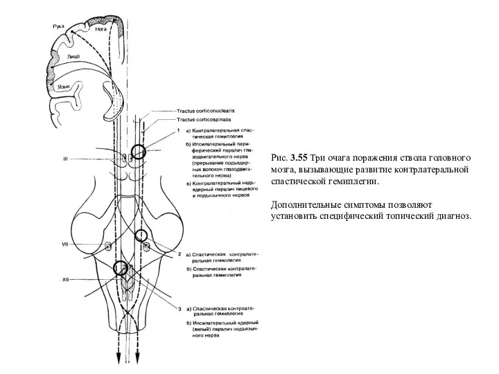 Рис. 3.55 Три очага поражения ствола головного мозга, вызывающие развитие контрлатеральной спастической