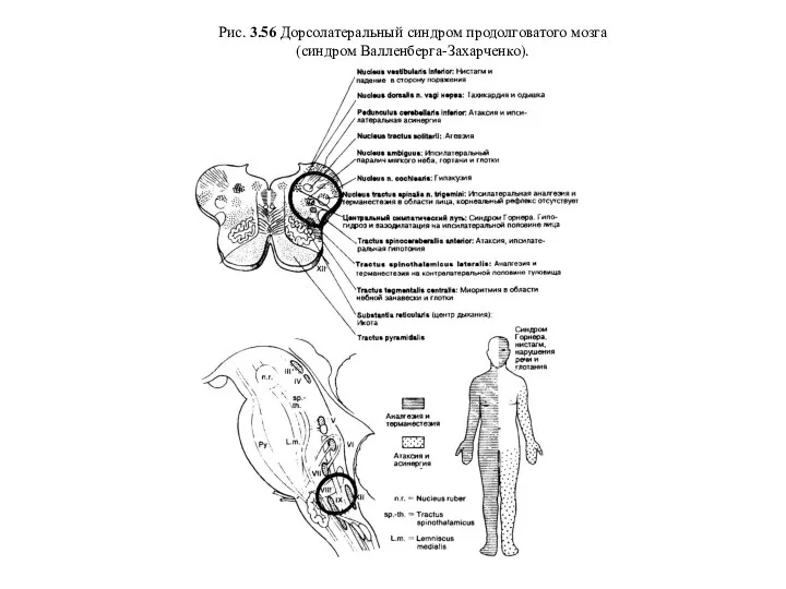 Рис. 3.56 Дорсолатеральный синдром продолговатого мозга (синдром Валленберга-Захарченко).
