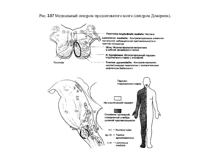 Рис. 3.57 Медиальный синдром продолговатого мозга (синдром Дежерина).